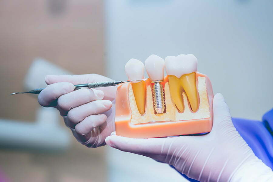 Urmează sa-ți pui implanturi dentare? Iată ce trebuie să știi!