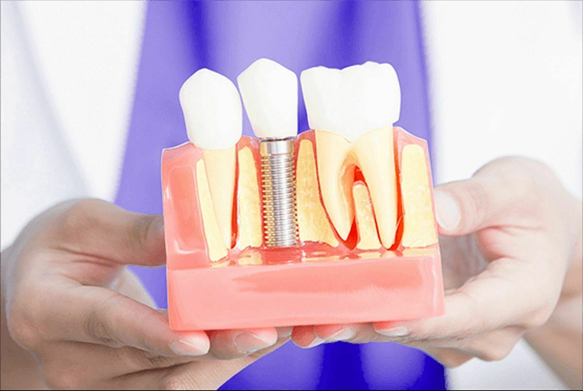 „Voi avea dureri dupa implanturile dentare?” Iata cum raspund specialistii la una dintre cele mai frecvente intrebari