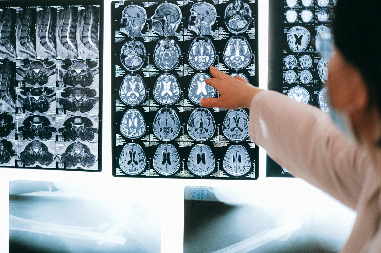 Cum se tratează anevrismul cerebral?