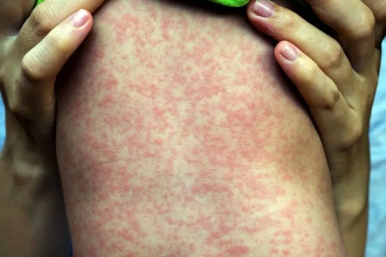 83 de morţi din cauza epidemiei de rujeola in Samoa