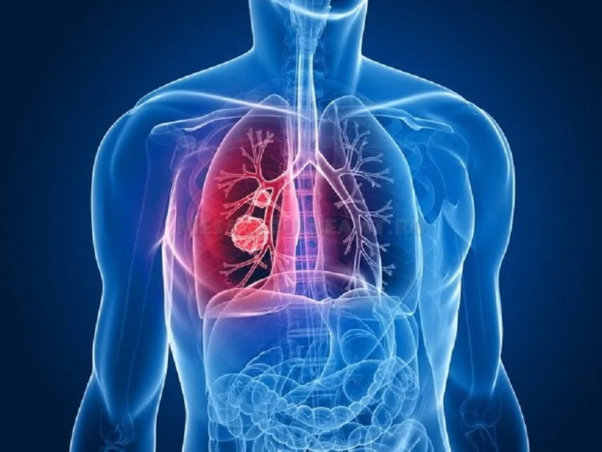 Proiect-pilot care prevede tratarea şi în sistem ambulatoriu a pacienţilor infectaţi cu tuberculoză